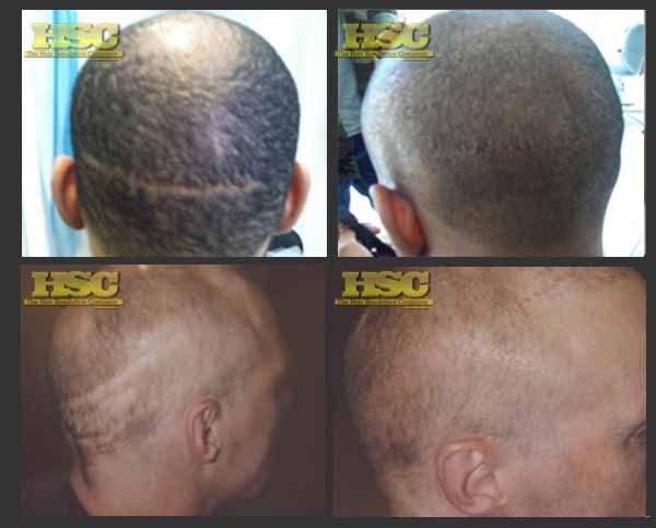 Medical SMP – Caucasian Men – The Hair Simulation Company: Caucasion