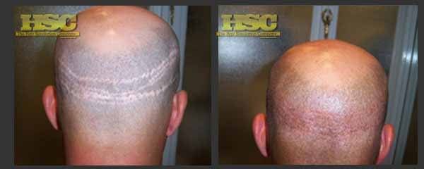 Medical SMP – Caucasian Men – The Hair Simulation Company: Caucasion