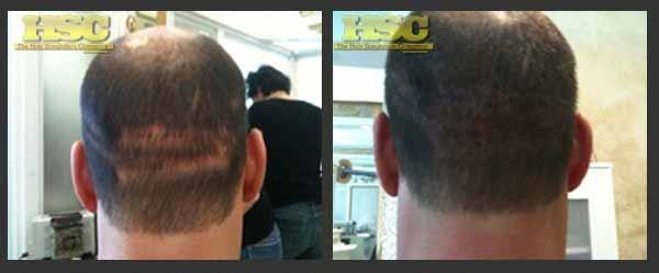 Medical SMP – Caucasian Men – The Hair Simulation Company: Caucasion