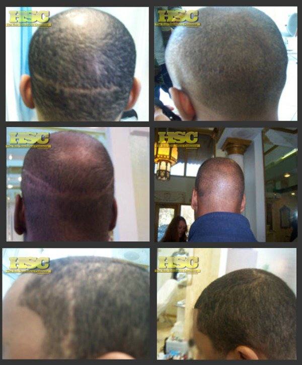 Scar Transplant Gallery – The Hair Simulation Company: DUAL B