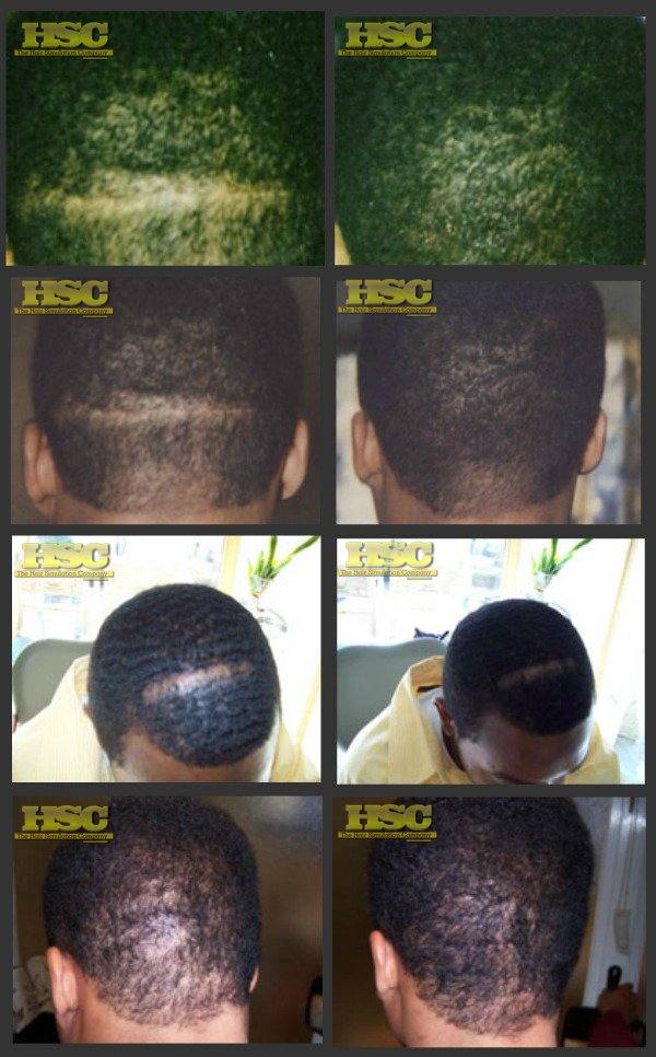 Scar Transplant Gallery – The Hair Simulation Company: DUAL C