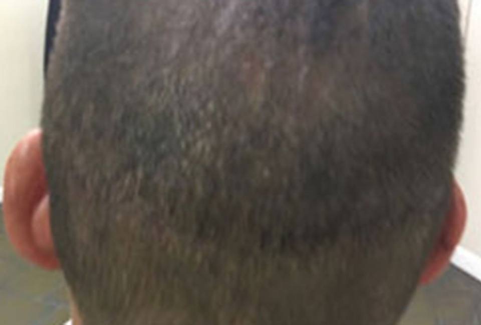 Hair Transplant – The Hair Simulation Company