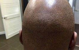 Medical SMP for Hair Transplant Scars – The Hair Simulation Company: medical smp img1