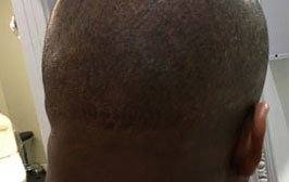 Medical SMP for Hair Transplant Scars – The Hair Simulation Company: medical smp img2