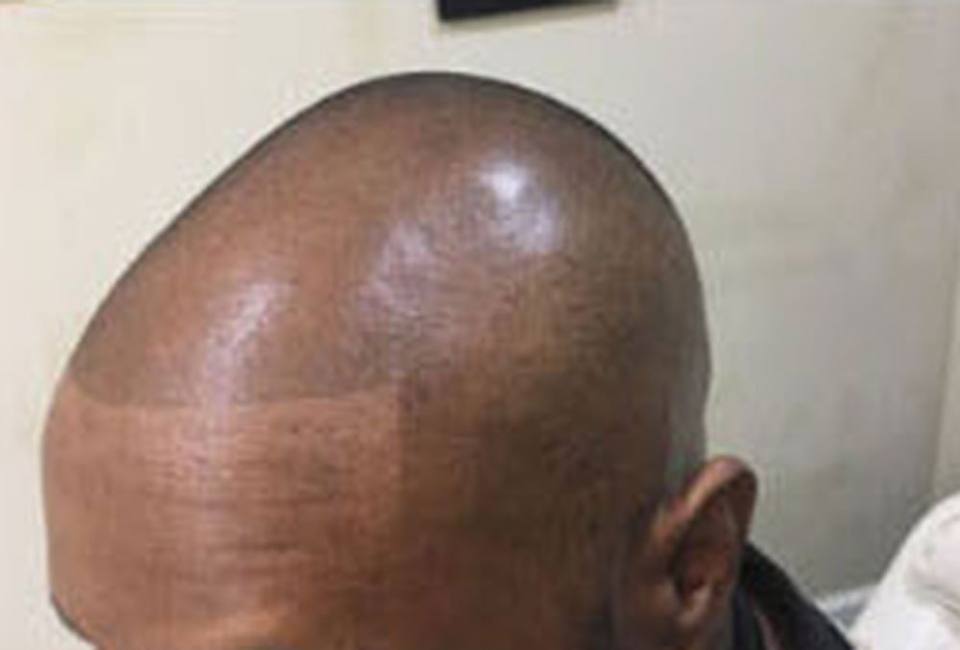 Hair Transplant + SMP – The Hair Simulation Company