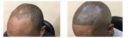 Before and after: SMP over thinning top and crown on a Black male client, by The Hair Simulation Co.