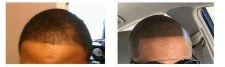 Before and after: SMP hairline by The Hair Simulation Co. on a Black male client